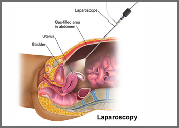 laparoscopy1